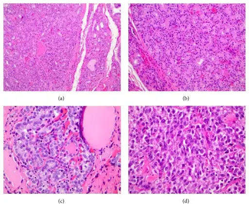 Graves Disease