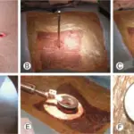 Gunshot Wound Injuries