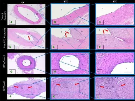 HYPERPLASIA