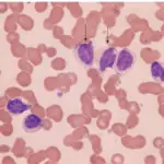 Hairy Cell Leukemia