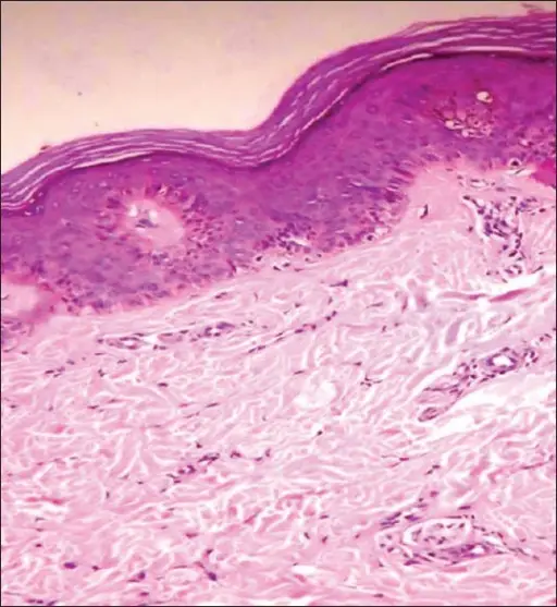 Halo Nevus