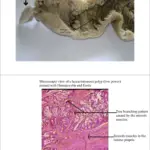 Hamartomatous Polyps