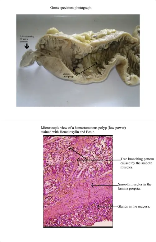 Hamartomatous Polyps