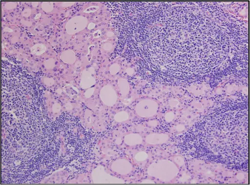 Hashimoto Thyroiditis