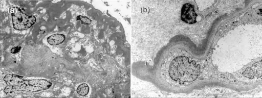 Heavy Chain Disease