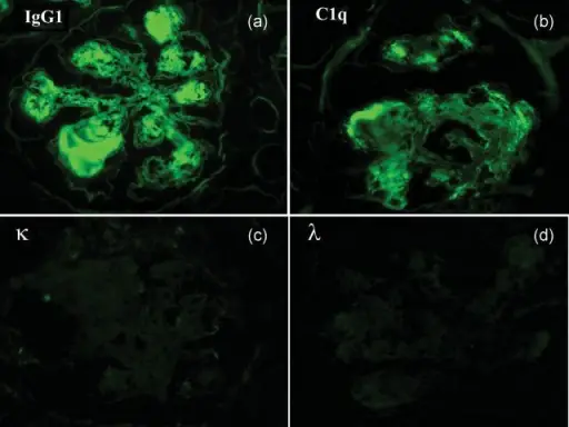 Heavy Chain Disease IgG