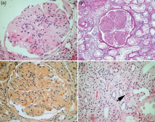 Heavy Chain Disease