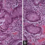 Helicobacter Pylori Gastritis