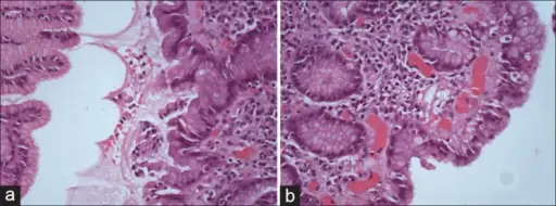 Helicobacter Pylori Gastritis