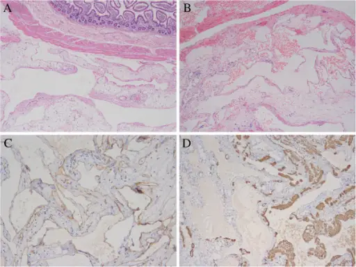 Hemangioma