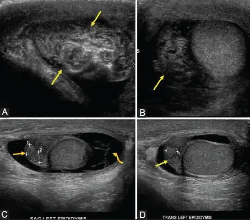 What is a Hematocele? – Pathosomes