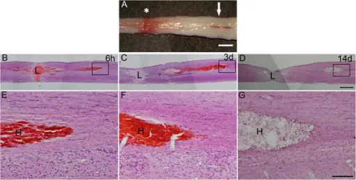 Hematoma