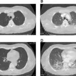 Hemodynamic Pulmonary Edema