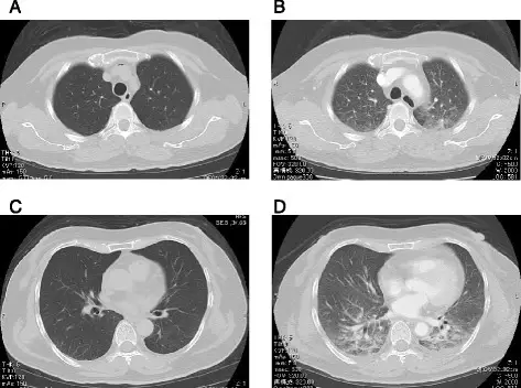 Hemodynamic Pulmonary Edema