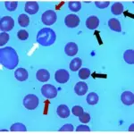 Hemolytic Anemia