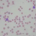 Hemolytic Anemia Due to Red Blood Cell Trauma