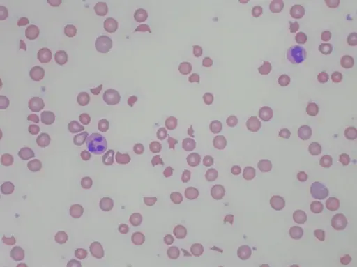 Hemolytic Anemia Due to Red Blood Cell Trauma