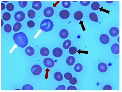 Hemolytic Anemia