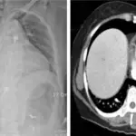 Hemopericardium