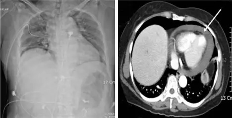 Hemopericardium