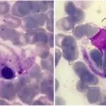 Hemophagocytic Lymphohistiocytosis