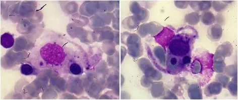 Hemophagocytic Lymphohistiocytosis