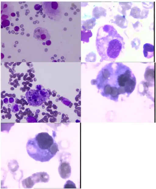 Hemophagocytic Lymphohistiocytosis