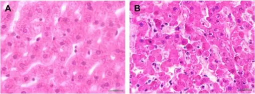 Hemorrhagic Disorders