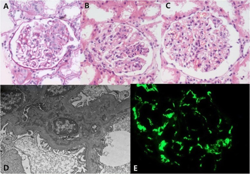 Henoch-Schonlein Purpura