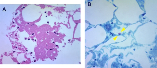Heparin-Induced Thrombocytopenia