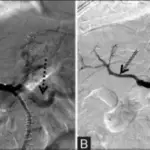 Hepatic Artery Compromise