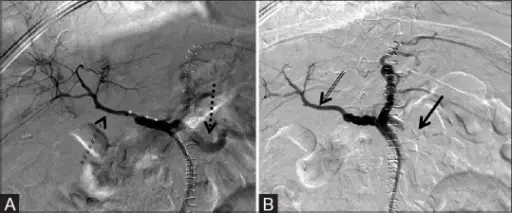 Hepatic Artery Compromise