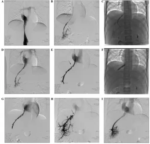 Hepatic Vein Thrombosis