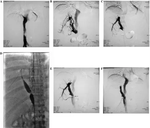 Hepatic Venous Outflow Obstruction