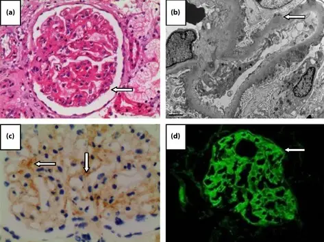 Hepatitis B Virus