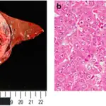 Hepatoblastoma