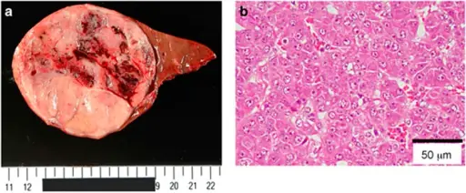 Hepatoblastoma