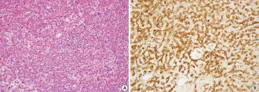 Hepatocellular Adenomas