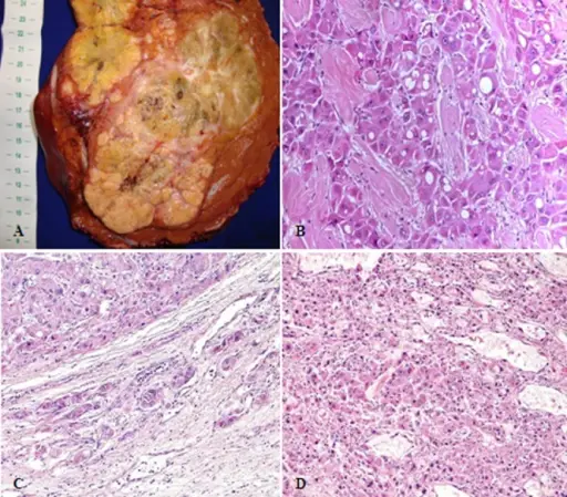 Hepatocellular Carcinoma