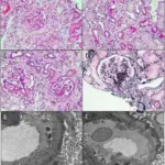 Hereditary Nephritis