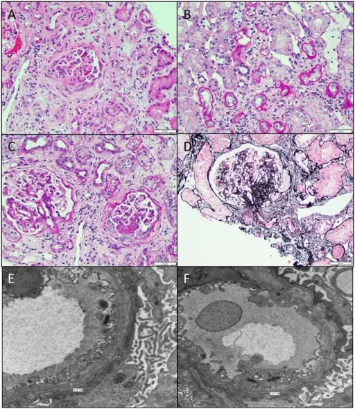 Hereditary Nephritis