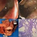 Hereditary Non-Polyposis Colorectal Cancer