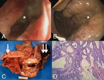 Hereditary Non-Polyposis Colorectal Cancer