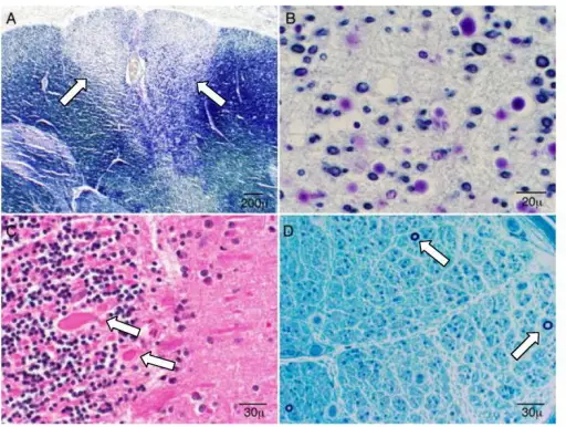 Hereditary Sensory Neuropathies