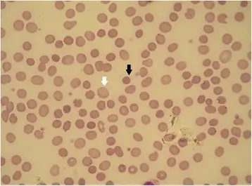 Hereditary Spherocytosis