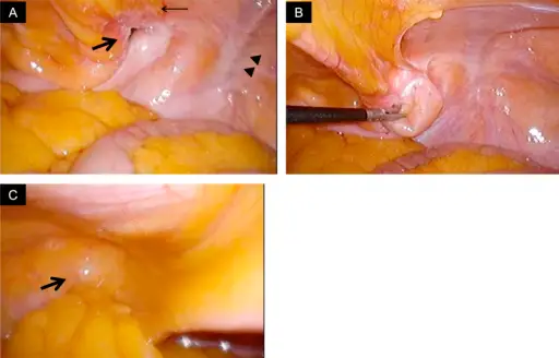 Hernias