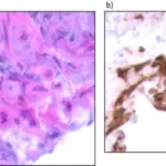 Herpes Simplex Virus