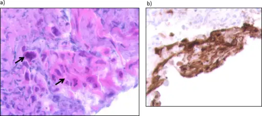 Herpes Simplex Virus