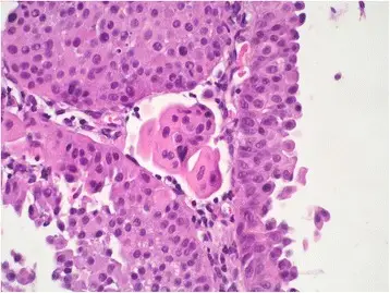 High Grade Papillary Urothelial Carcinoma