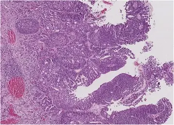 High Grade Papillary Urothelial Carcinoma